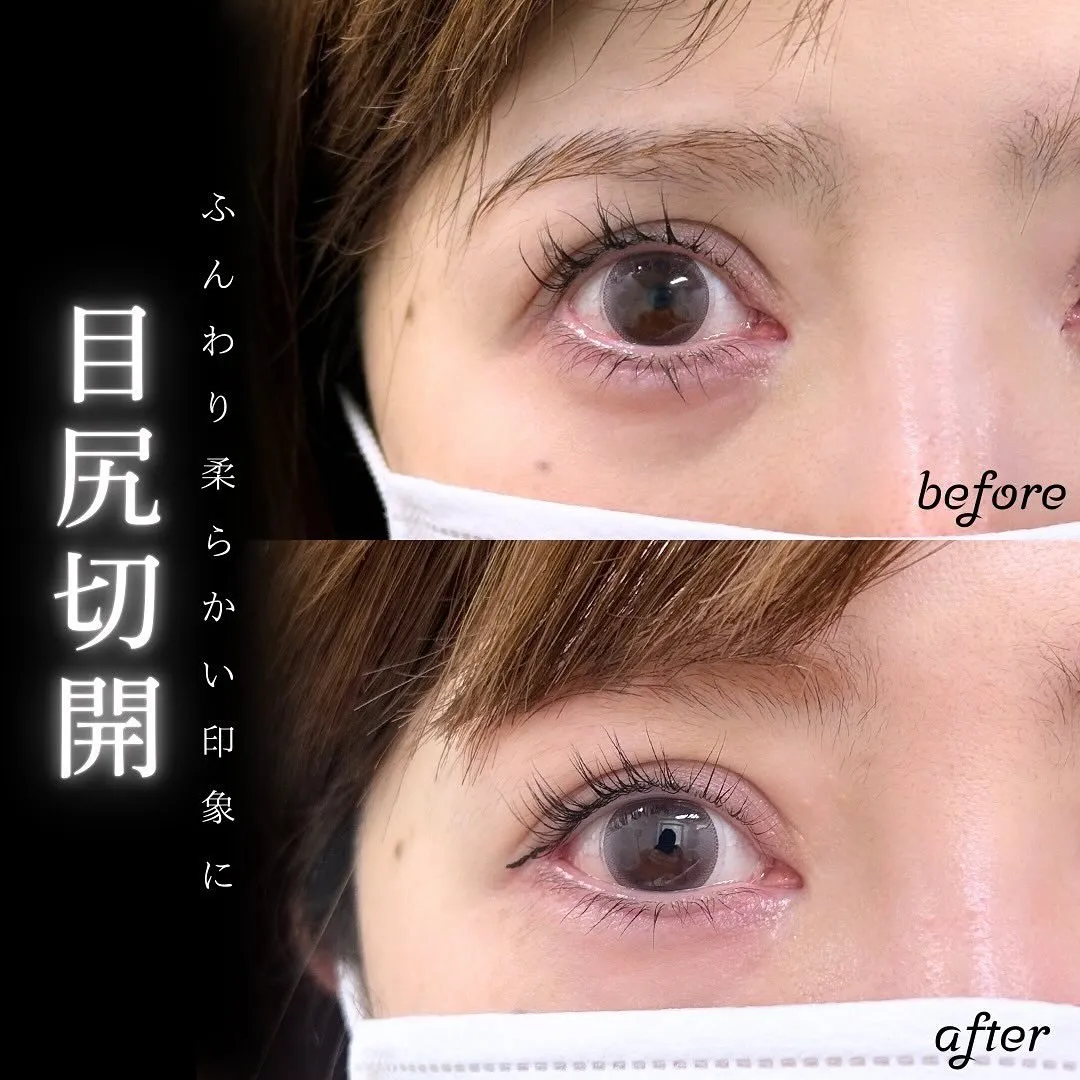目尻切開の症例写真（施術前・施術後）