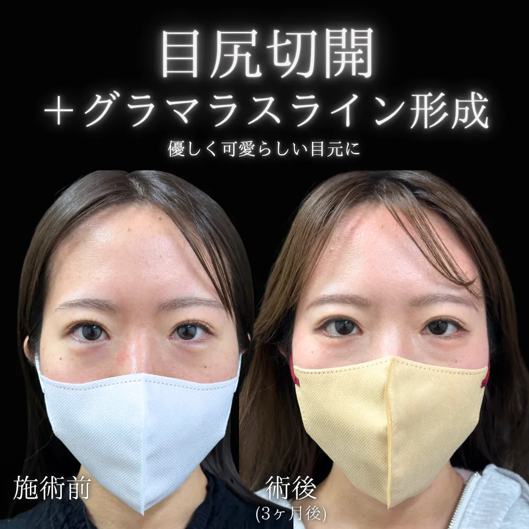 目尻切開の症例写真（施術前・施術後）