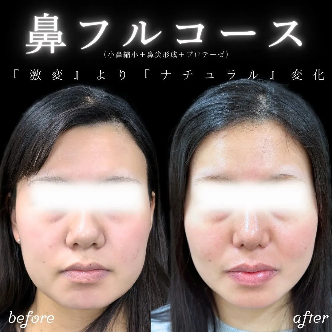 鼻フルの症例写真（施術前・施術後）