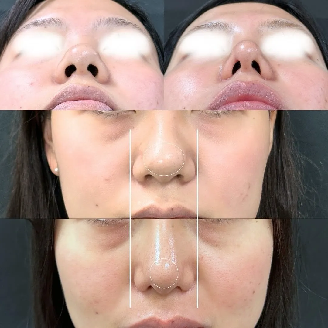 鼻フルの症例写真（施術前・施術後・正面・下からの角度）