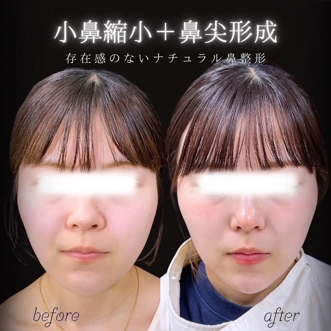 小鼻縮小と鼻尖形成の症例写真（施術前・施術後）