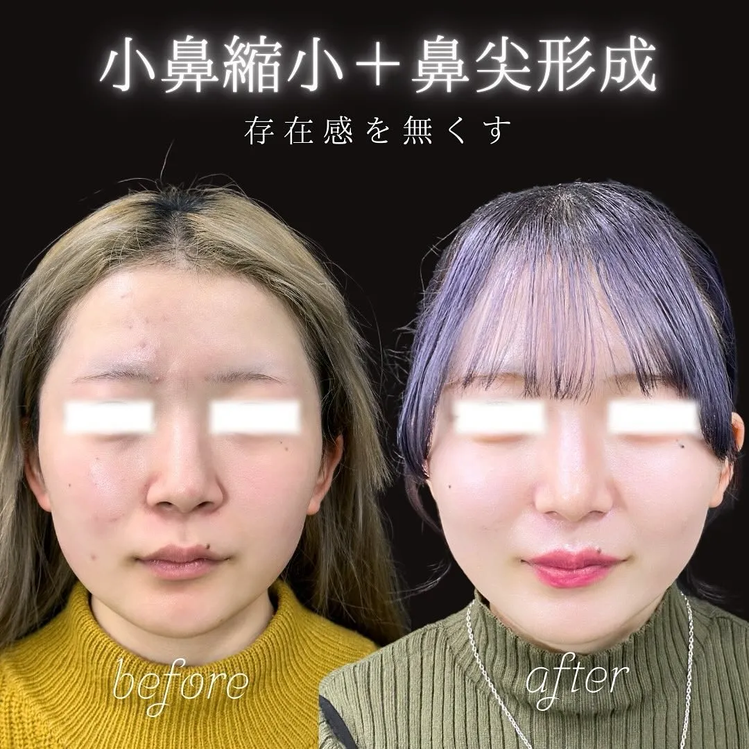 小鼻縮小と鼻尖形成の症例写真（施術前・施術後）