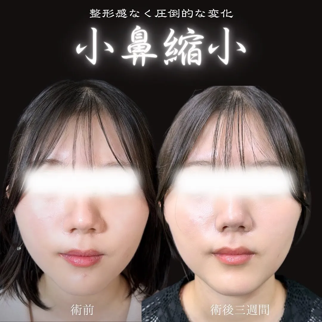 小鼻縮小の症例写真（施術前・施術後3週間）