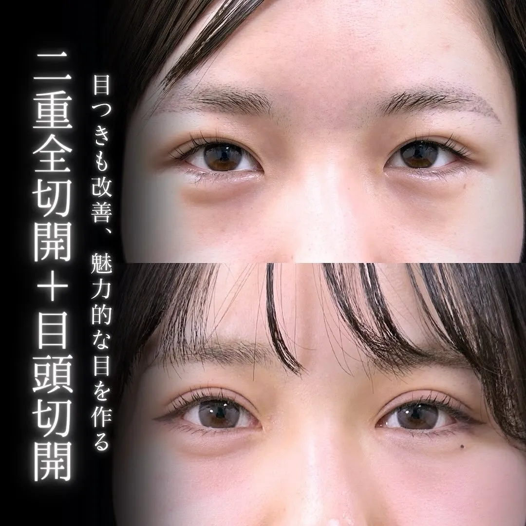 二重全切開と目頭切開の症例写真（施術前・施術後）