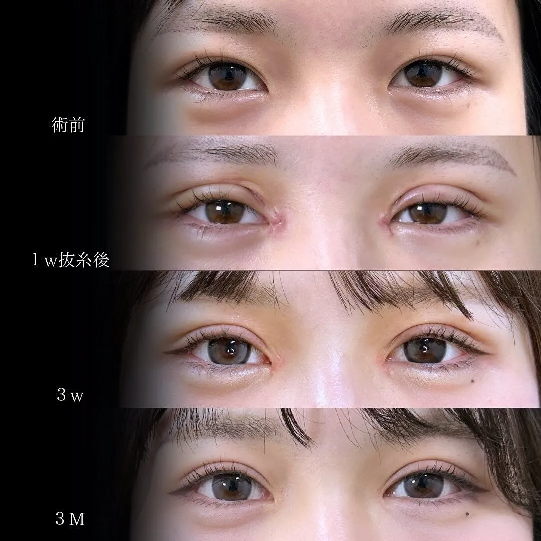 二重全切開と目頭切開の症例写真（施術前・1週間抜糸後・施術3週間後・施術3か月後）