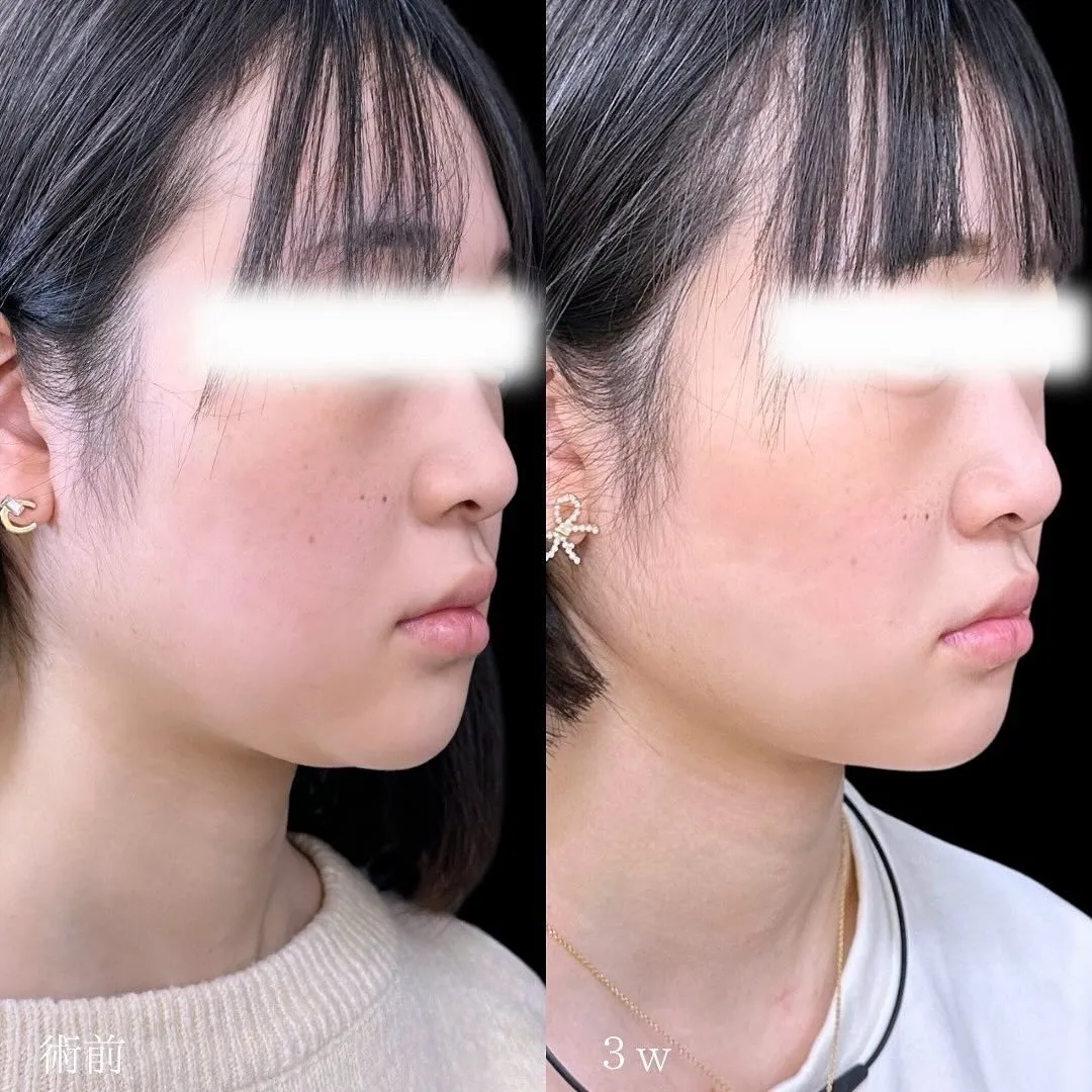 脂肪吸引（頬・顎下）の症例写真（施術前・施術後3週間・斜め）