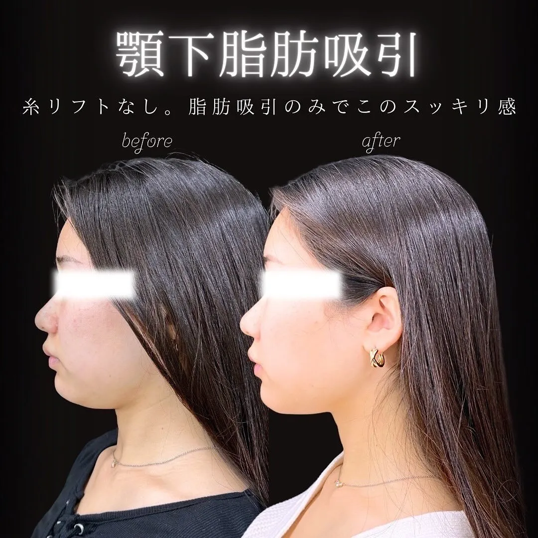 脂肪吸引（顎下）の症例写真（施術前・施術後3週間・横顔）