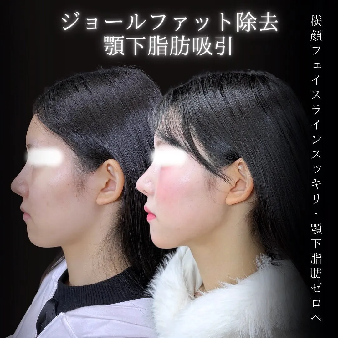 ジョールファット除去の症例画像