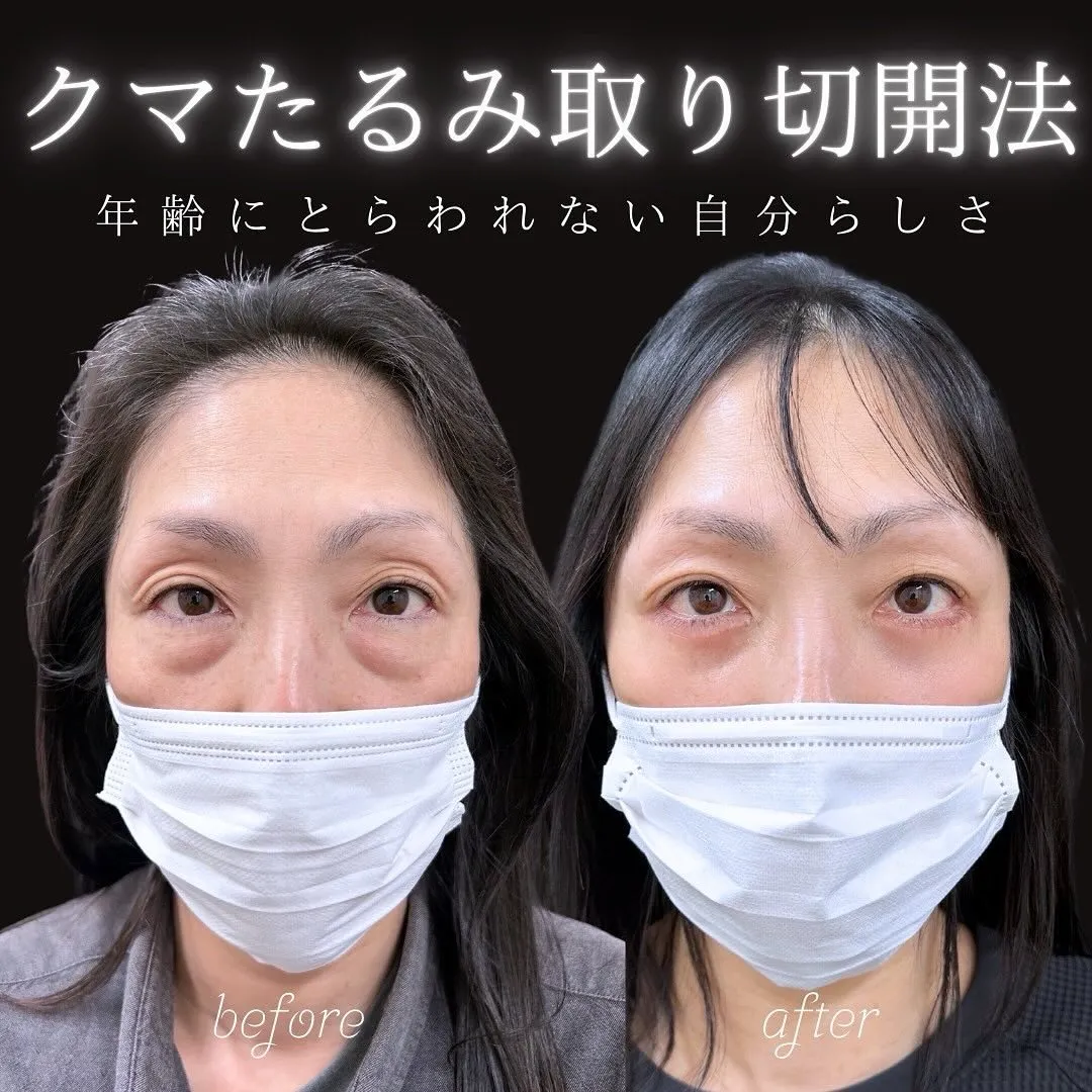 クマ取りたるみ切開法の症例写真（施術前・施術後2か月）