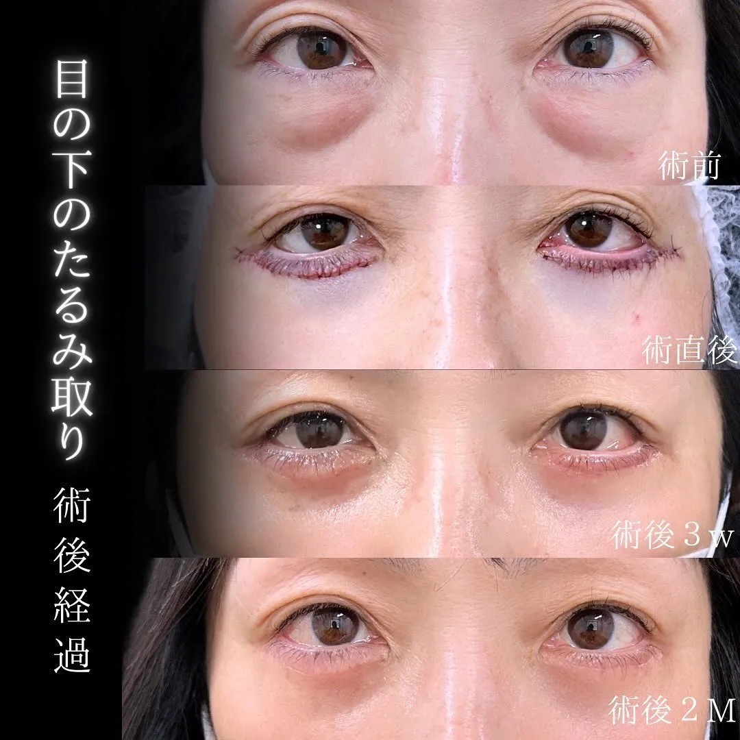 クマ取りたるみ切開法の症例写真（施術前・施術直後・3週間後・施術後2か月）