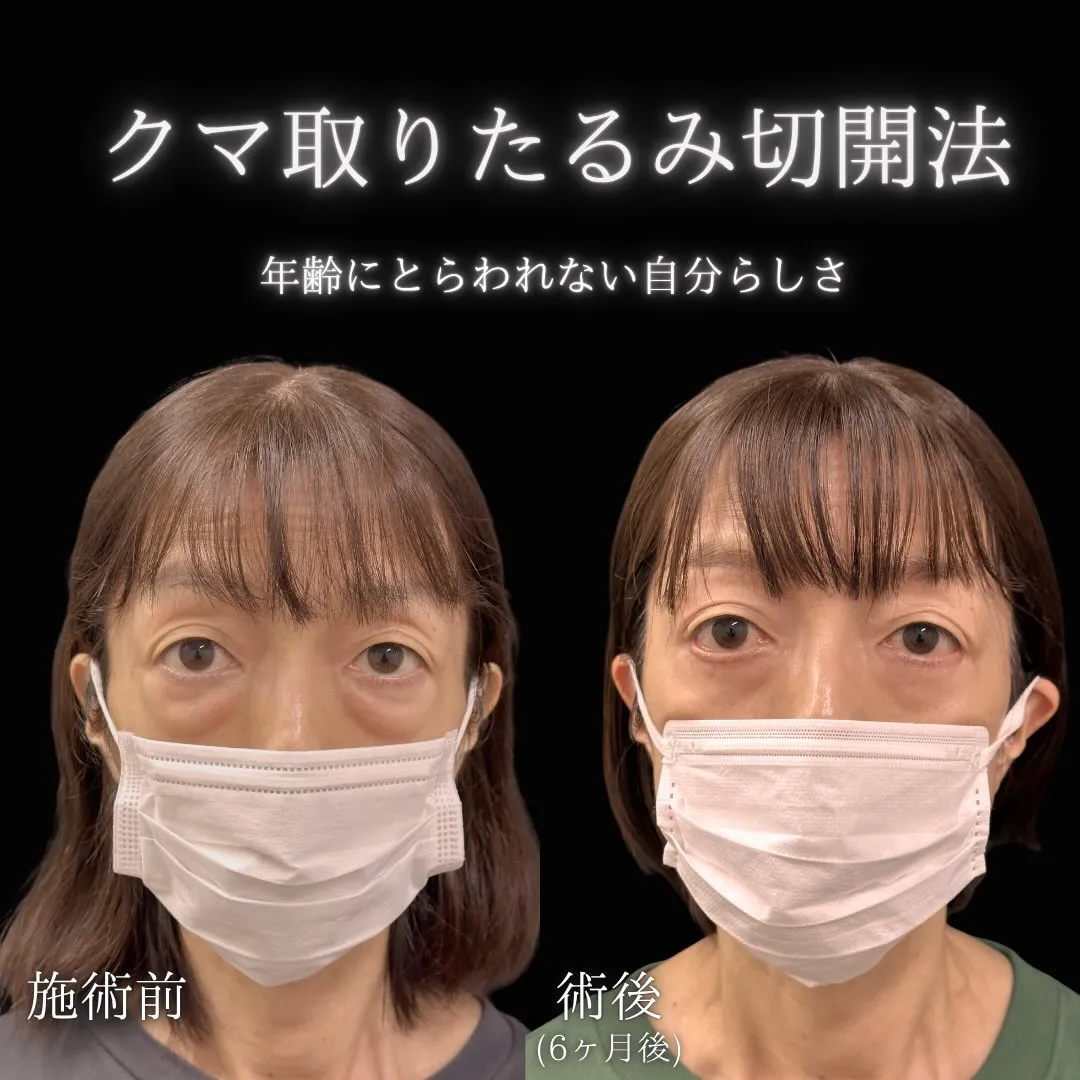 クマ取りたるみ切開法の症例写真（施術前・施術後6か月）