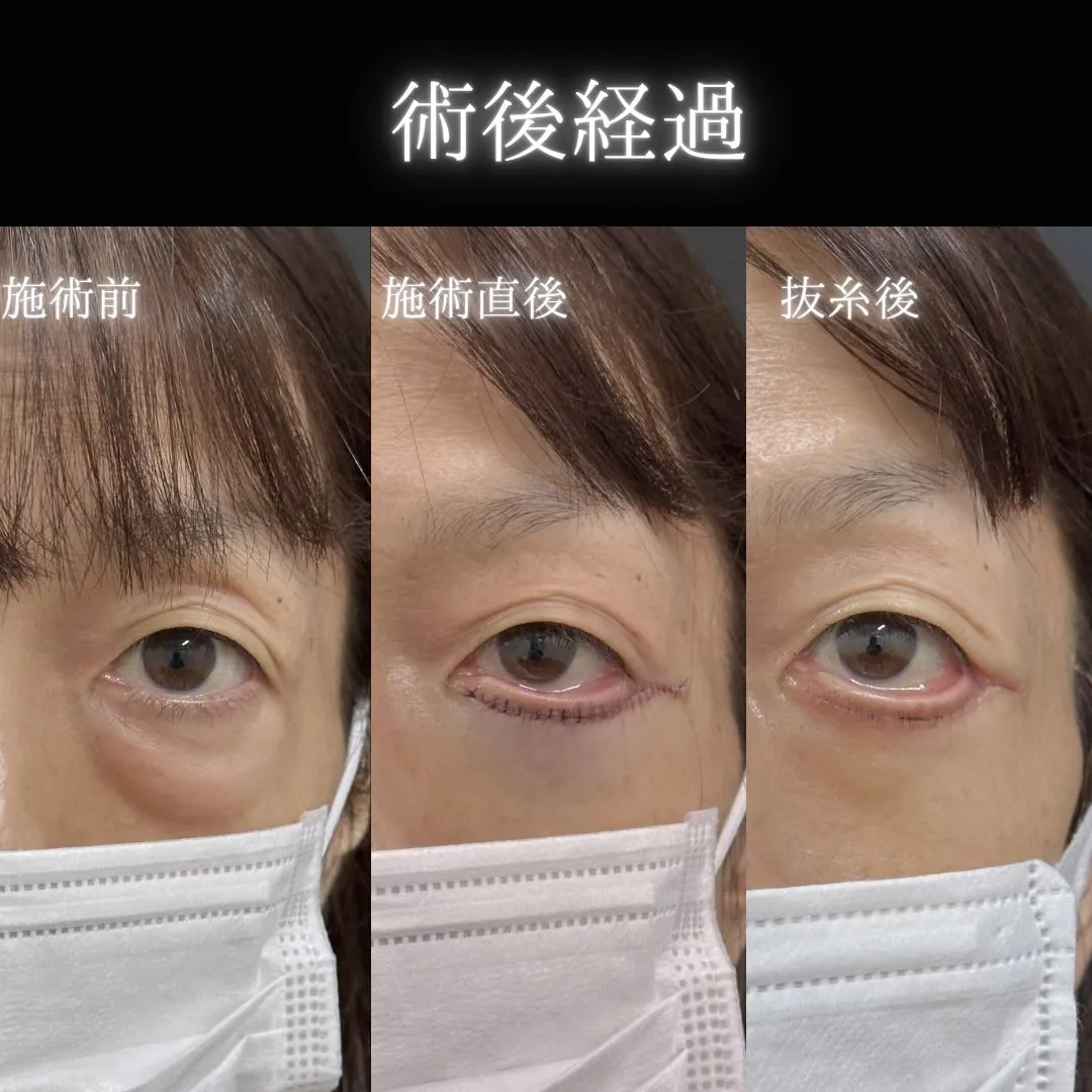 クマ取りたるみ切開法の症例写真（施術前・施術直後・抜糸後）