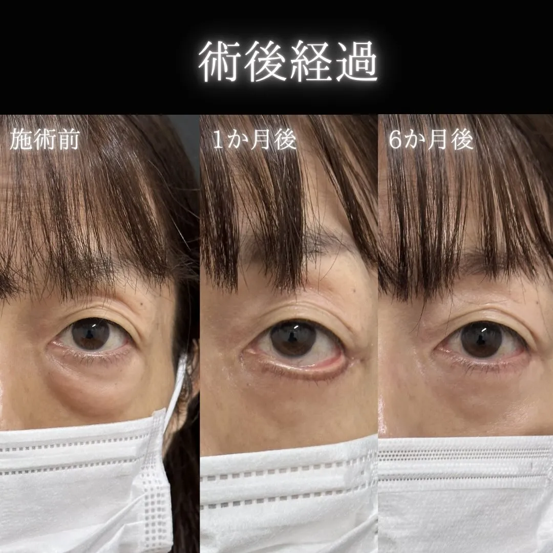 クマ取りたるみ切開法の症例写真（施術前・施術1か月後・施術6か月後）