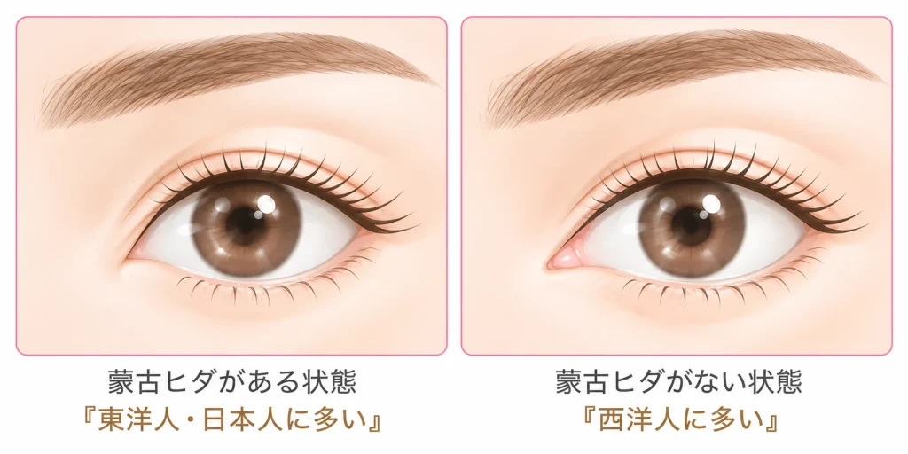 蒙古ひだのある目と蒙古ひだのない目で目頭切開の適応を解説