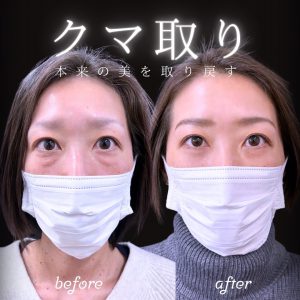 クマ取りのビフォーアフター写真