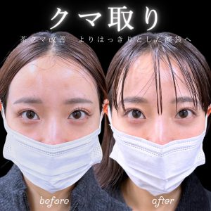 20代女性の切らないクマ取りのビフォーアフターの写真