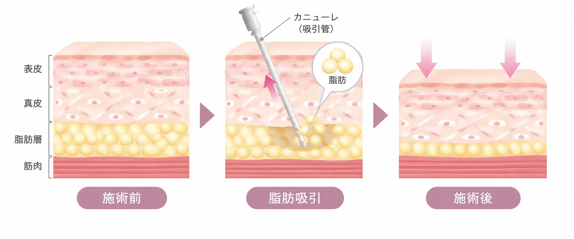 脂肪吸引の施術前後と仕組みの図解イラスト