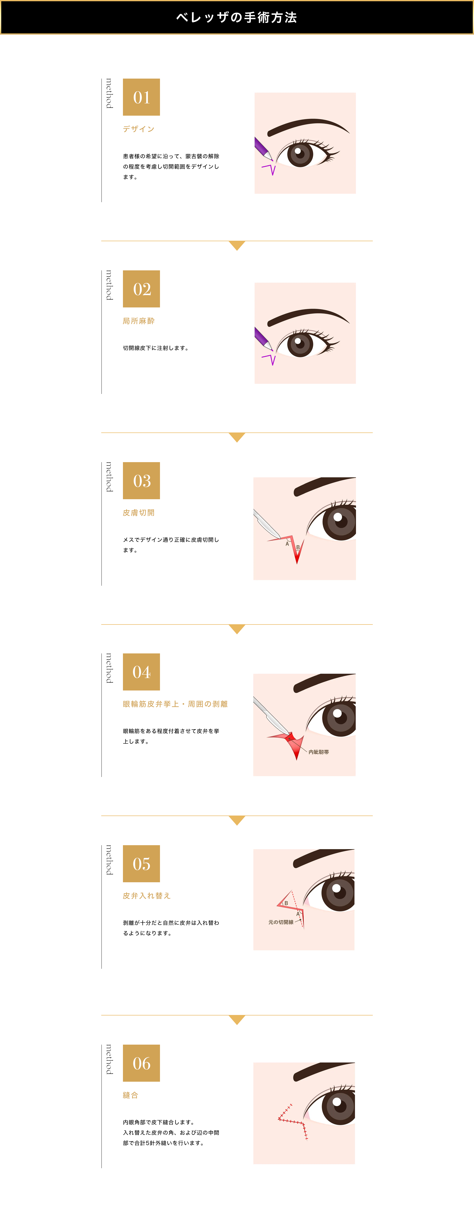 目頭切開の手術方法