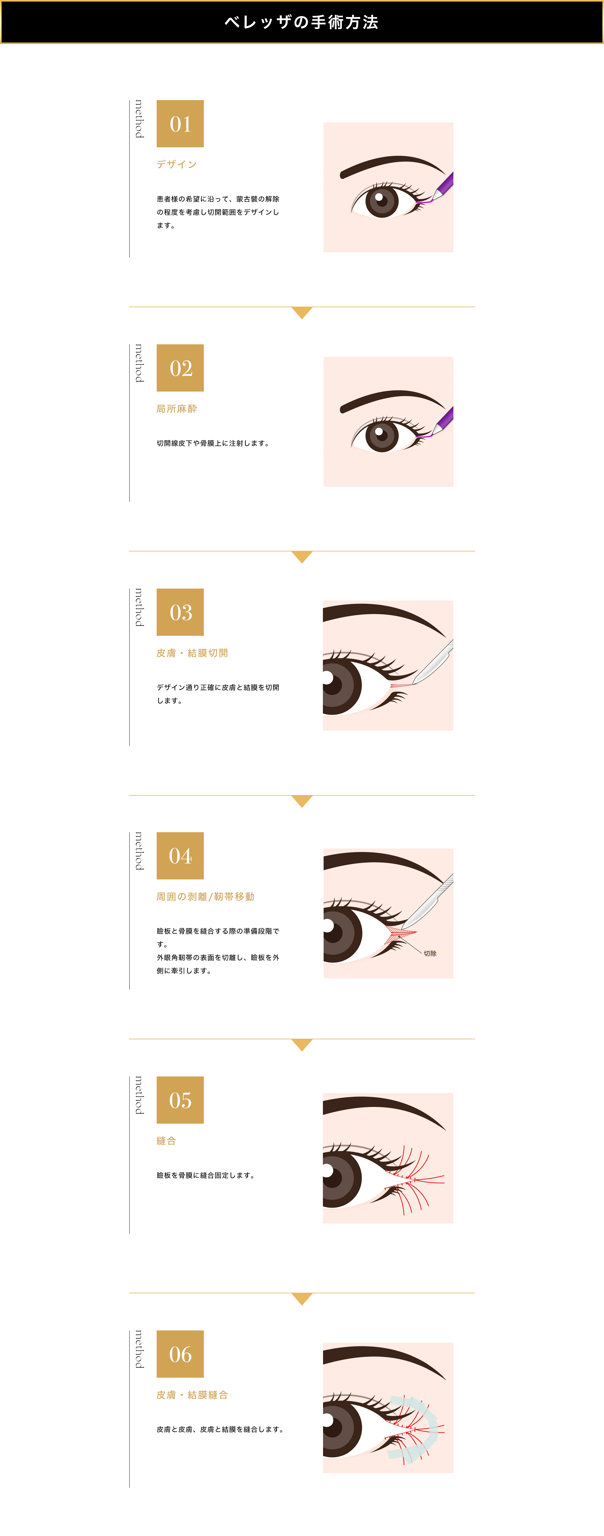 ベレッザクリニックでの目尻切開の手術方法