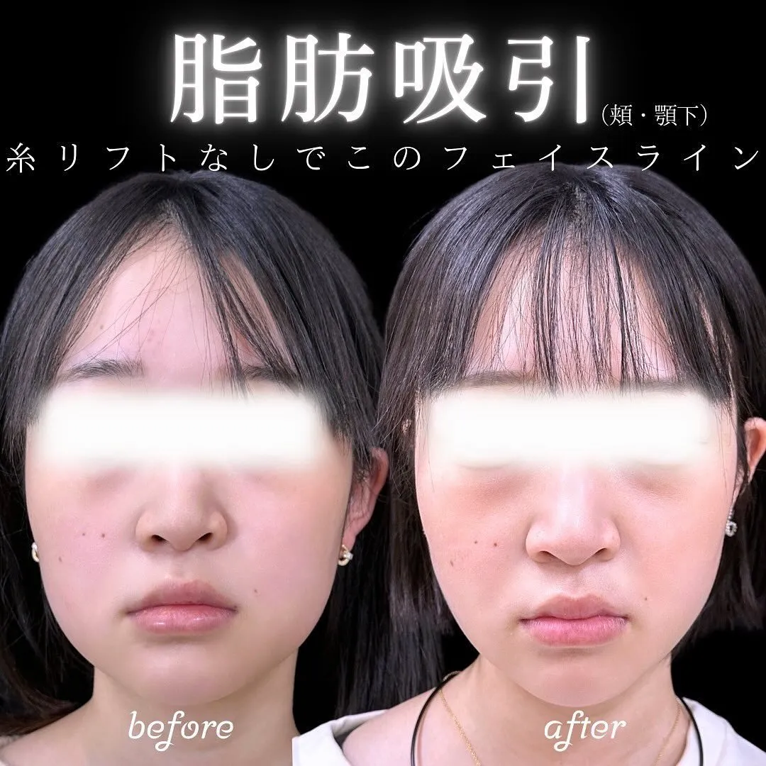 脂肪吸引(頬・顎下) 症例写真1-1