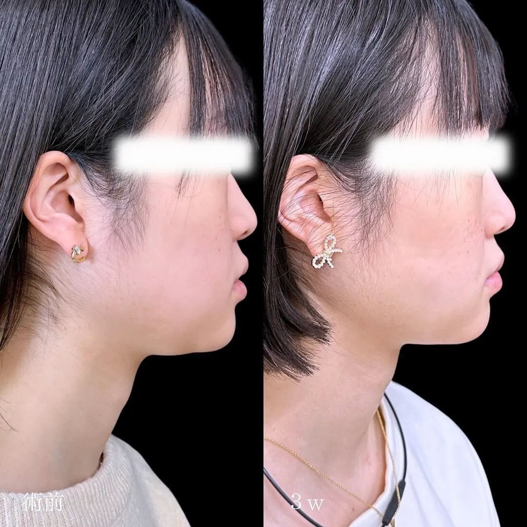 脂肪吸引(頬・顎下) 症例写真1-3
