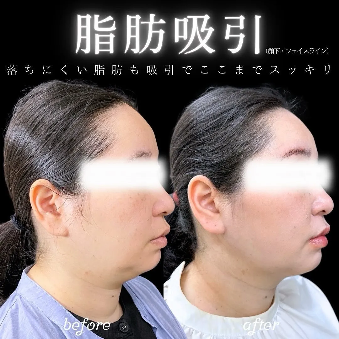 脂肪吸引(顎下) 症例写真2-1